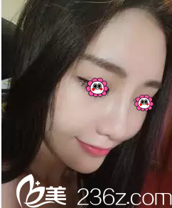 北京麥西美嘉硅膠假體隆鼻案例第56天效果 北京麥西美嘉硅膠假體隆鼻案例第56天效果