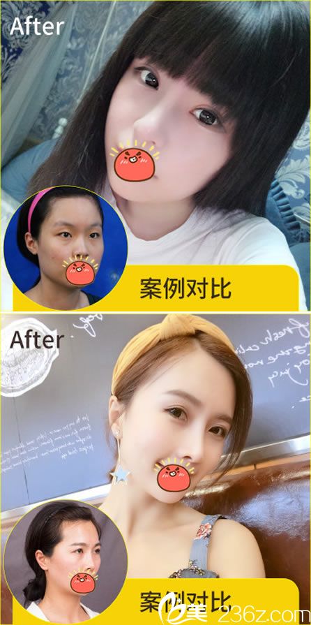 義烏陽光整形醫(yī)院雙眼皮隆鼻<span style= 義烏陽光整形醫(yī)院雙眼皮隆鼻<span style=