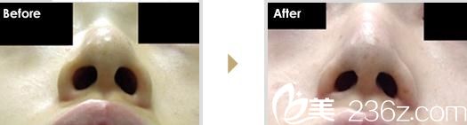 小鼻縮小術(shù)(外側(cè)法)1.jpg 鼻翼縮小術(shù) 小鼻縮小術(shù)(外側(cè)法)1.jpg 鼻翼縮小術(shù)