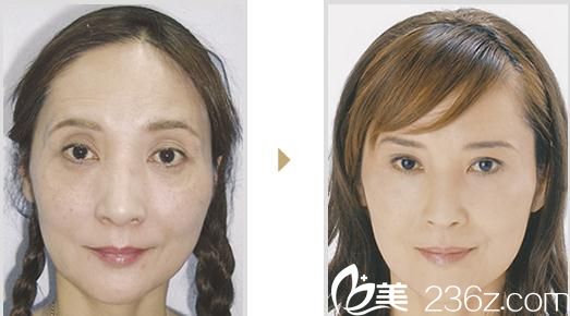 微整玻尿酸注射 微整玻尿酸注射