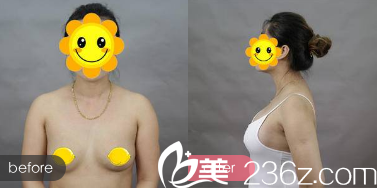 盧剛假體隆胸手術(shù)效果 盧剛假體隆胸手術(shù)效果