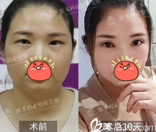 趁艾長安院長來溫嶺維多利亞坐診去體驗(yàn)了新研發(fā)的顯微精雕雙眼皮和開眼角,恢復(fù)7天效果不錯(cuò)