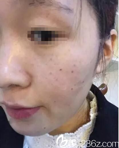 術(shù)前雀斑明顯