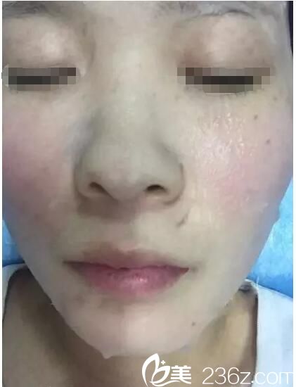 剛做完激光祛斑術(shù)后敷面膜