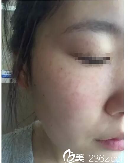 術(shù)后4天臉上開始結(jié)痂皮