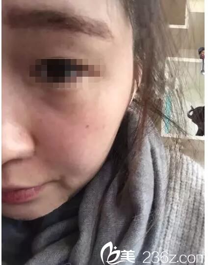 術(shù)后一周臉上斑點恢復