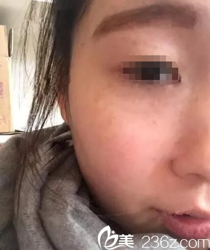 術(shù)后20天斑點淡化