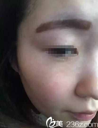 皮秒祛斑和大Q祛斑一樣嗎?看遺傳麻子臉在泰州華美做大Q祛雀斑術(shù)后無后遺癥效果還不錯