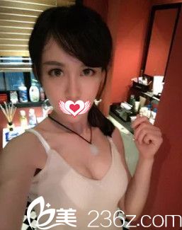 自體脂肪豐胸26天胸部變大 自體脂肪豐胸26天胸部變大