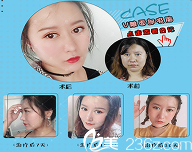 昆明美伊萊整形面部吸脂手術(shù)