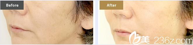 去除法令紋 去除法令紋