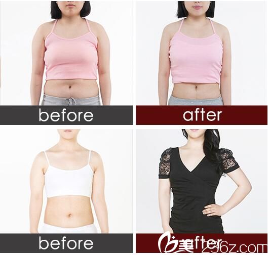 吸脂減肥對比<span style=