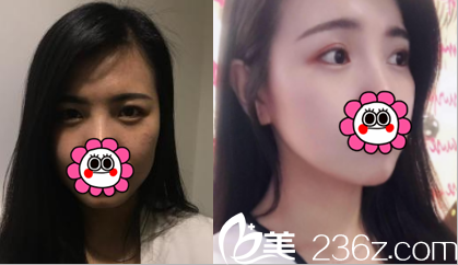 北京壹加壹切開雙眼皮案例