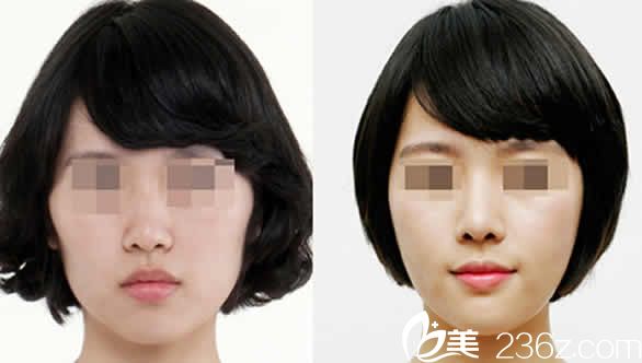 太原歐美蓮整形全臉自體脂肪填充前后對比圖