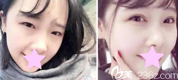 太原歐美蓮整形姚冰雙眼皮案例效果圖