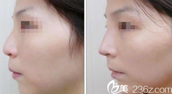 太原歐美蓮整形張世民鼻綜合案例圖