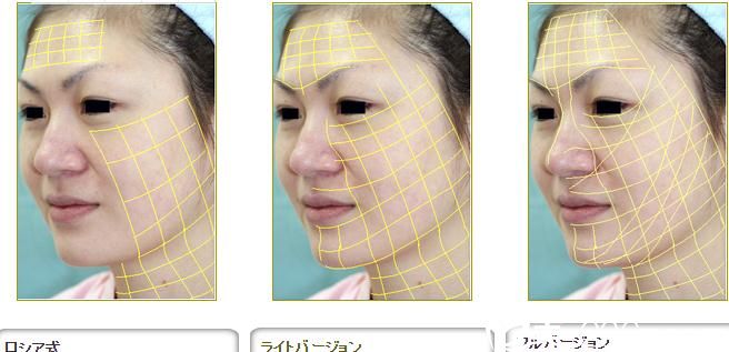 金線美容術(shù)