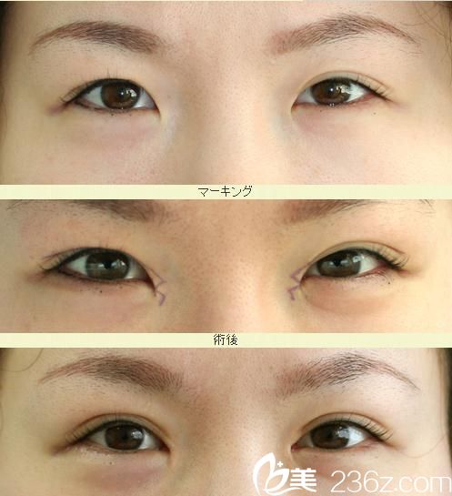 埋設(shè)法雙眼皮