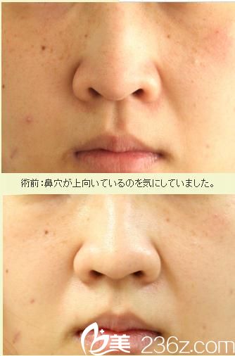 鼻翼縮小術(shù)