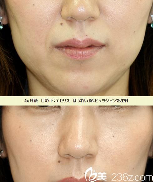 微整注射去法令紋