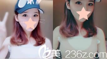 <!--<i data=20240703-sp></i>-->整形<!--<i data=20240703-sp></i>-->院長假體隆胸6天照 <!--<i data=20240703-sp></i>-->整形<!--<i data=20240703-sp></i>-->院長假體隆胸6天照