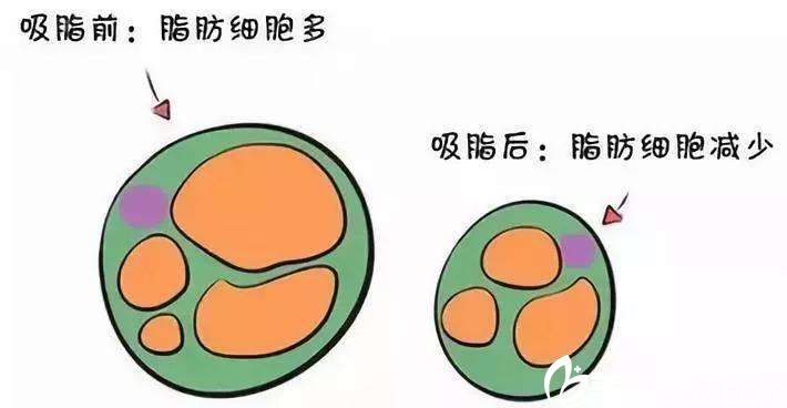 吸脂瘦身的原理