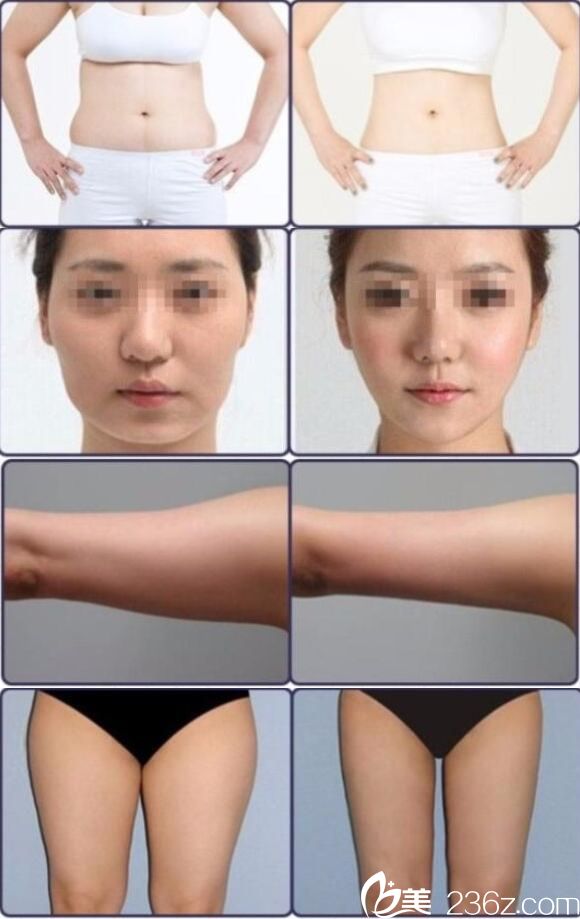 <!--<i data=20240703-sp></i>-->吸脂案例