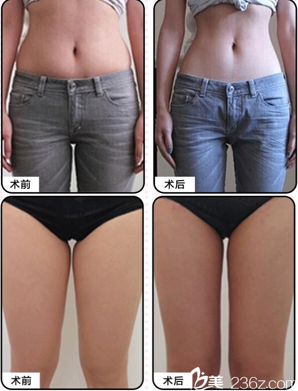 武漢美基元吸脂案例