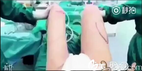 武漢壹加壹大腿吸脂術(shù)中即刻效果對(duì)比