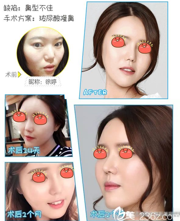 紹興藝美雷金同注射玻尿酸隆鼻案例 紹興藝美雷金同注射玻尿酸隆鼻案例