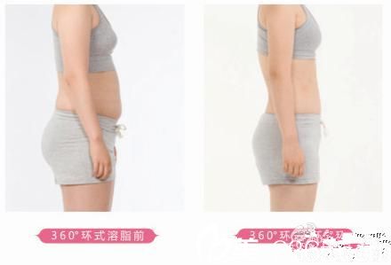 <!--<i data=20240703-sp></i>-->吸脂案例