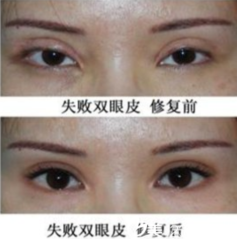 衡陽(yáng)雅美眼失敗修復(fù)真人案例