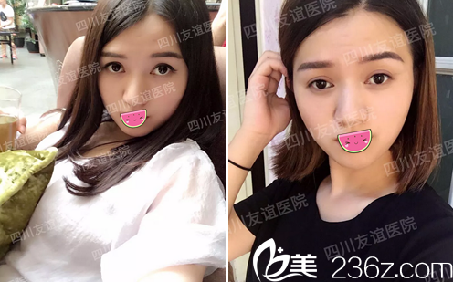成都友誼醫(yī)院李繼華V-line改臉型術(shù)后一個月