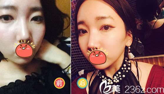 紹興藝美方倫磊全切雙眼皮案例 紹興藝美方倫磊全切雙眼皮案例