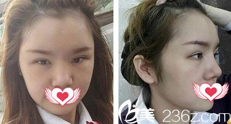 做自體脂肪填充額頭與太陽(yáng)穴術(shù)后一周