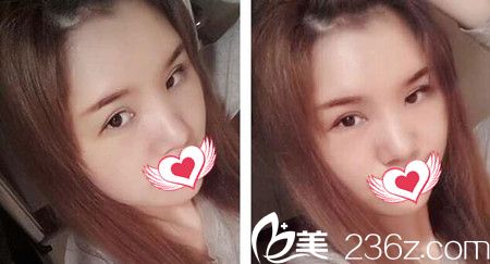 做自體脂肪填充額頭與太陽(yáng)穴術(shù)后20天效果