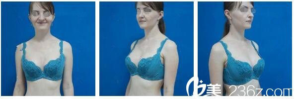 假體隆胸術(shù)后一個(gè)月恢復(fù)