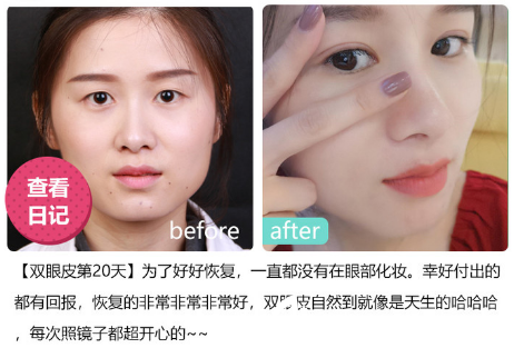 深圳美萊醫(yī)院林登文做的雙眼皮案例