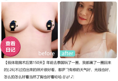 深圳美萊醫(yī)院郭杰做的假體隆胸哪里