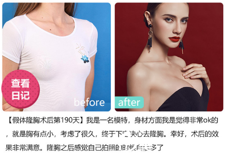 深圳美萊醫(yī)院徐英假體隆胸案例