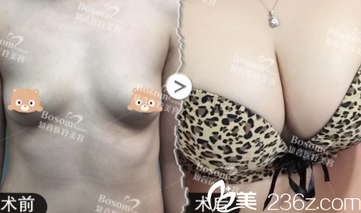 北京知音劉東升自體脂肪豐胸案例