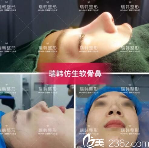 瑞韓仿生軟骨鼻優(yōu)勢介紹 瑞韓仿生軟骨鼻優(yōu)勢介紹