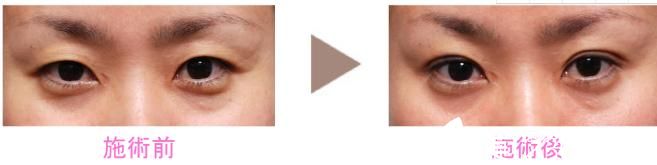 新垣形成外科醫(yī)院 埋設(shè)雙眼皮