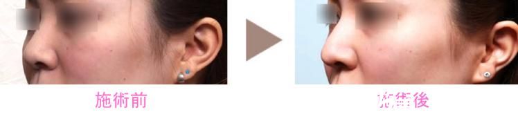 日本新垣形成外科醫(yī)院隆鼻