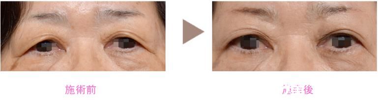 野村宏史 眼瞼下垂修正