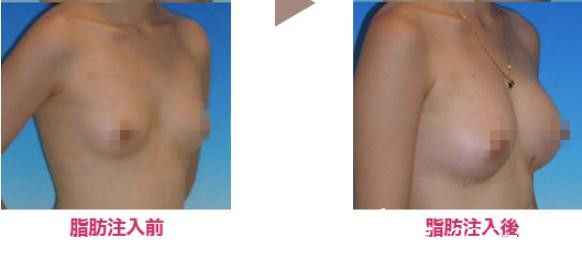 野村宏史脂肪豐胸