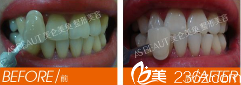重慶美侖美奐皓齒美白案例