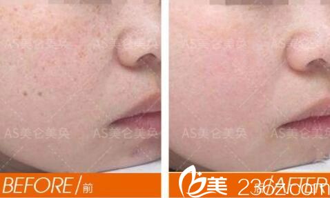 重慶美侖美奐超皮秒嫩膚案例