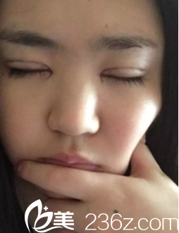 我發(fā)現(xiàn)我的切口一點(diǎn)都不腫