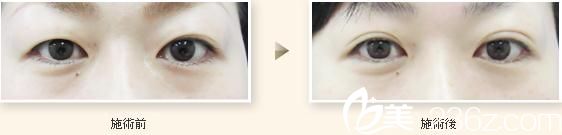 日本 TIARA 整形外科醫(yī)院雙眼皮手術(shù)